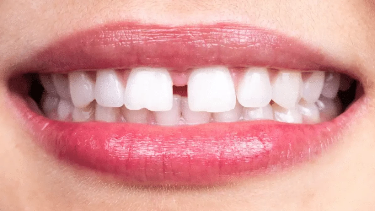 General Dentistry Embracing Natural Solutions for Closing Teeth Gaps