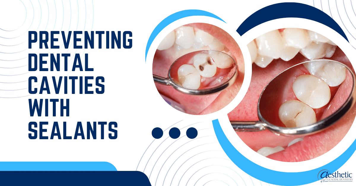 Preventing Dental Cavities with Sealants