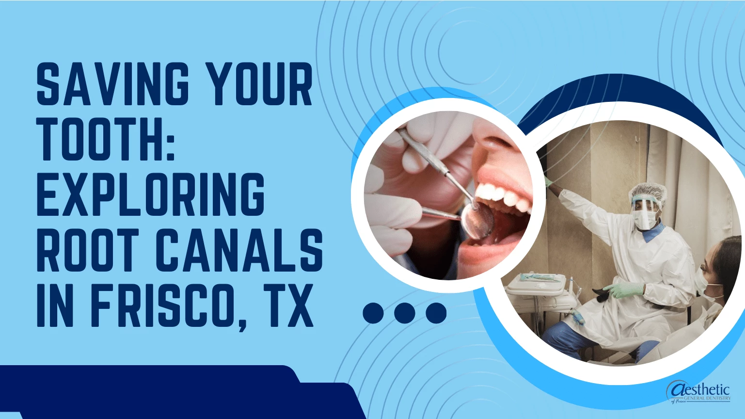 Saving Your Tooth Exploring Root Canals in Frisco, TX