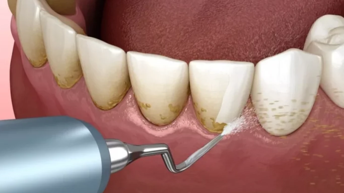 Teeth Cleanings Eradicating Stubborn Intrinsic Stains on Teeth