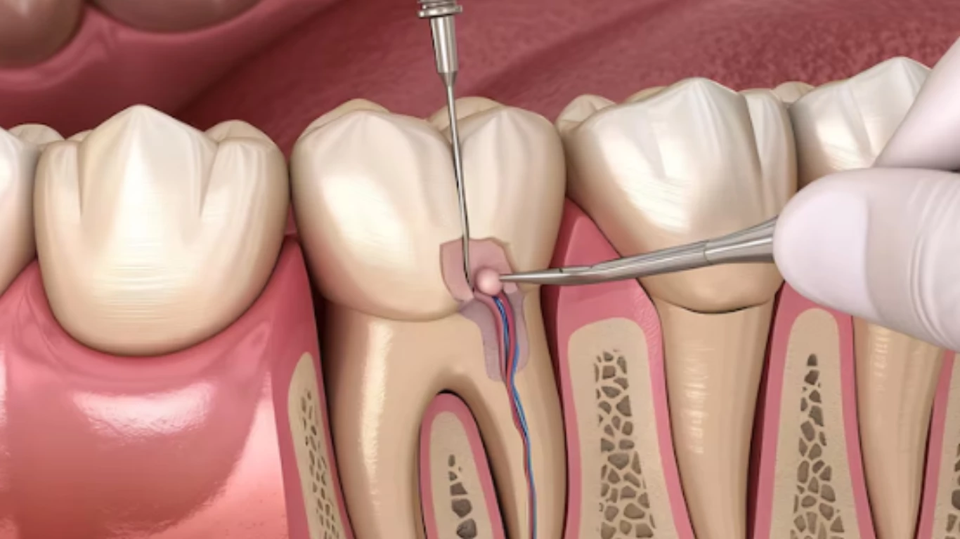 When a Root Canal Is the Best Option What to Expect from Your Dentist