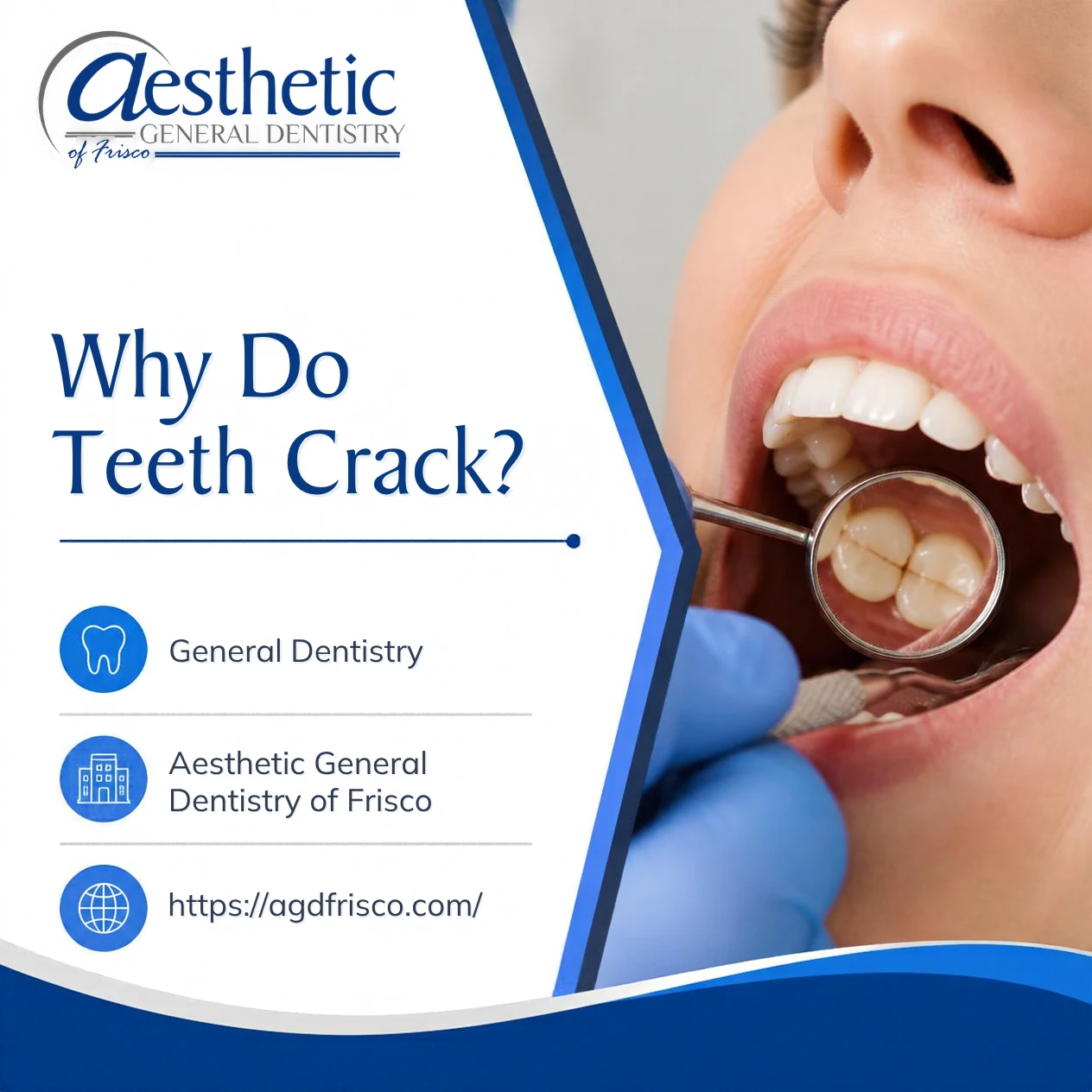 Why Do Teeth Crack?