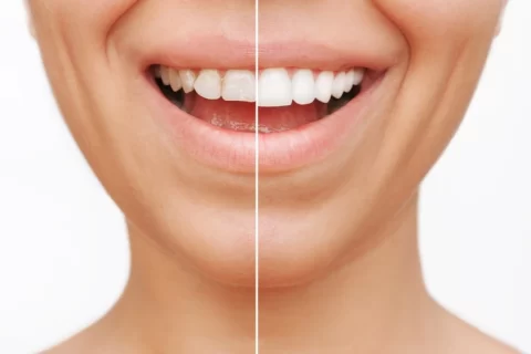 before and after closeup of porcelain veneers